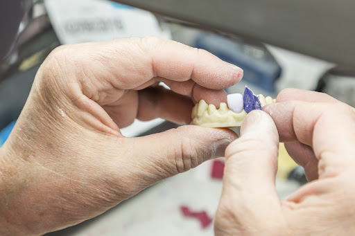 Inlays and onlays are advanced restorative dental treatments designed to repair damaged or decaye… post image