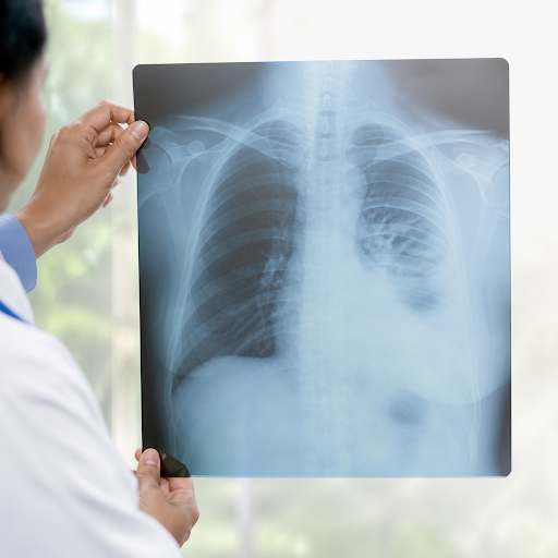 Pleural effusion can cause chest pain, breathlessness and a persistent cough, and needs expert ev… post image