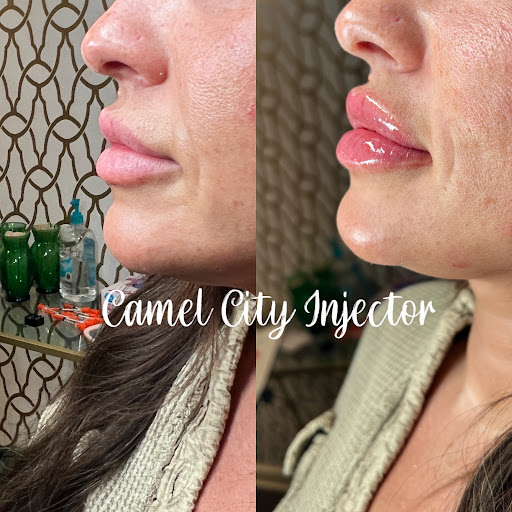 Camel City Injector