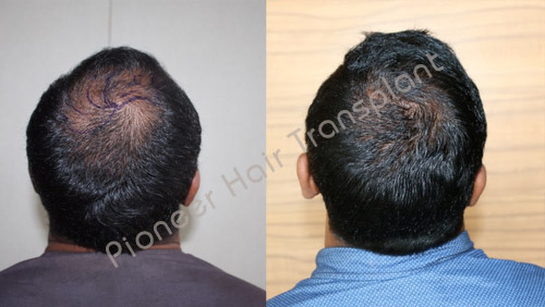 🏆Best Hair Transplant Clinic Bangalore-Pioneer Hair Clinic - Hair  Transplant Clinic in Bangalore