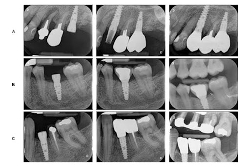 At Dr Khanna’s Dental Clinic, Lajpat Nagar, Delhi, we provide advanced digital dental X-rays to d…