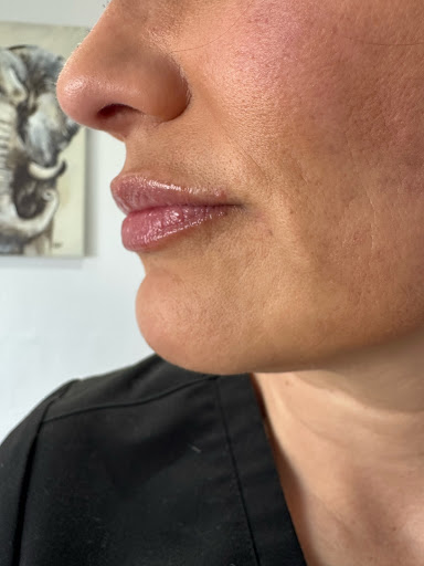 Botox by shy