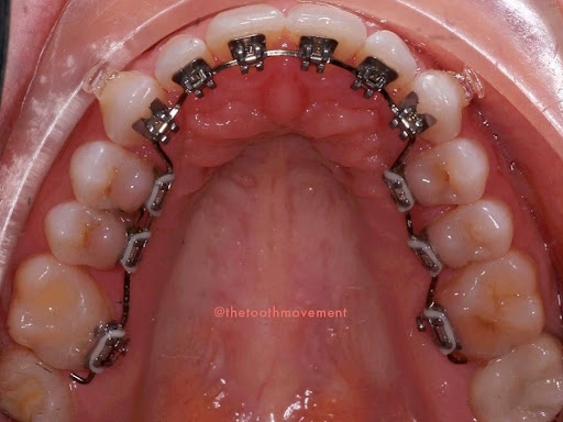 #braces doctor in Gorakhpur, post image
