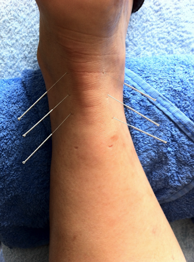 Acupuncture Renée-Lise Lavoie Saint-Constant - Thumbnail