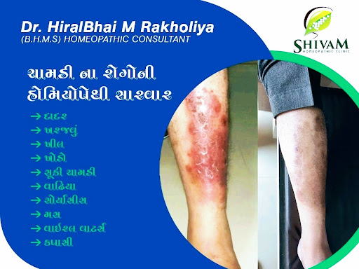 Homeopathic treatment for skin diseases post image