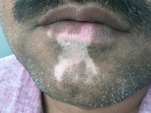 Leucoderma post image