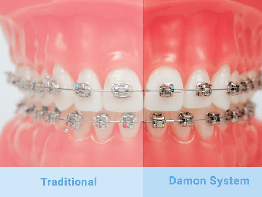 Self-ligating braces come either in traditional metal, ceramic, or clear brackets, and are made f…