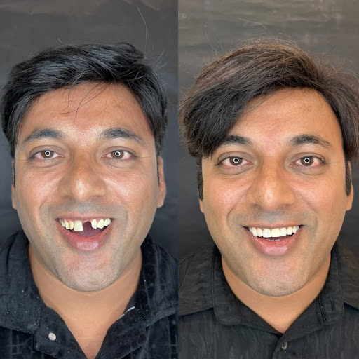 Upgrade your smile with Zirconia Crowns 🦷✨ post image