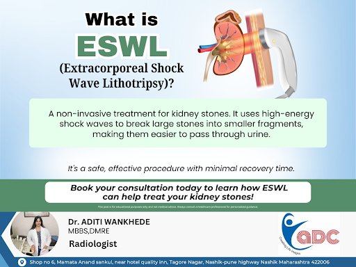 ESWL (Extracorporeal Shock Wave Lithotripsy) is a safe, noninvasive procedure that uses shock wav…
