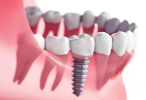 Implant Dentist Albany