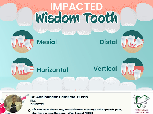Impacted Wisdom Tooth post image