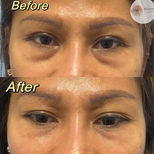 Blossom Injectables Gallery - Australia