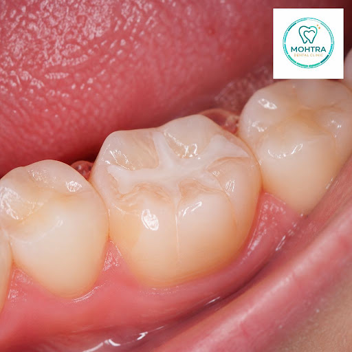 Worried about frequent cavities, especially in your child’s back teeth? Dental sealants are a qui… post image