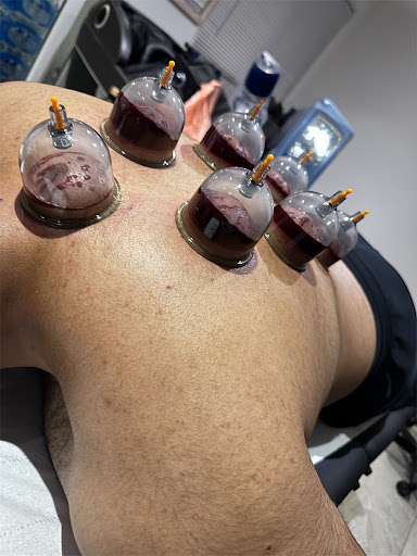 Cupping by Hamza
