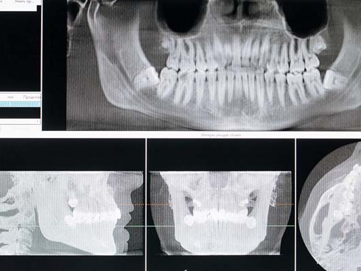 Botox Treatment for TMD and TMJ