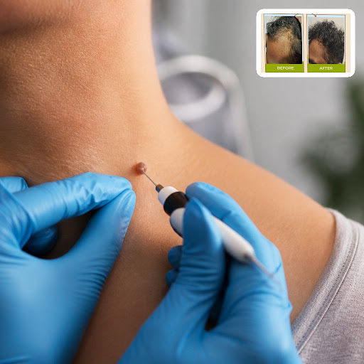 Bothered by moles, skin tags or other skin growths? At Dr Akankshas skin clinic in Tilak Chowk, K… post image