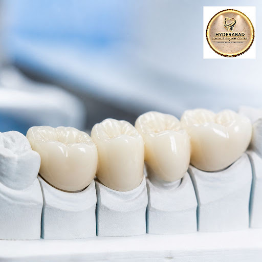Enjoy long-lasting, natural-looking tooth restoration with advanced DMLS crowns at HYDERABAD DENT… post image
