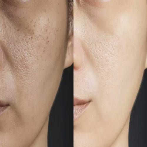 Open Pores Treatment post image