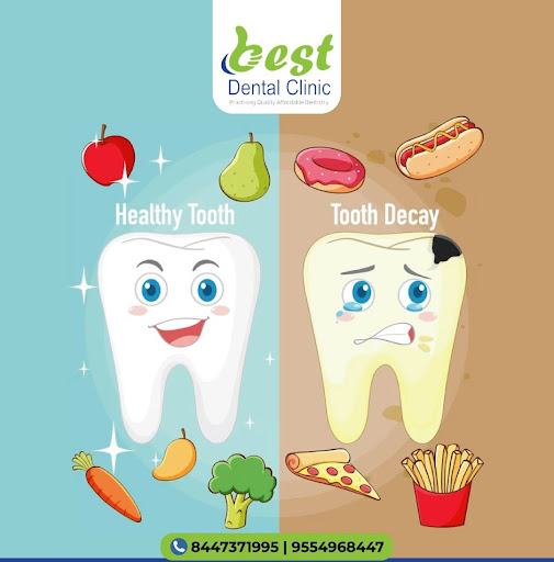 Tooth decay is damage that occurs to your teeth, which can potentially result in cavities, dental… post image