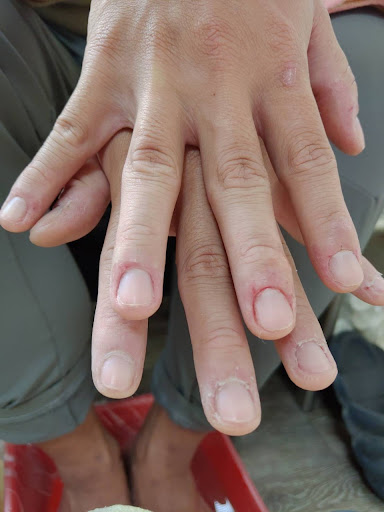 湘皮凍甲推薦評價、營業時間、服務項目、價格 - 專業凍甲治療與指甲護理