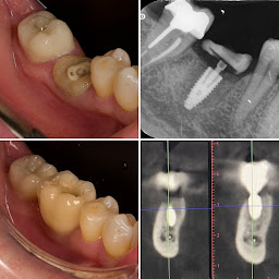 Photo n°19 de Dr. Mickael GUETTA Chirurgien Dentiste - Implantologie - Endodontie - Esthétique à Vaujours (Cabinet dentaire)