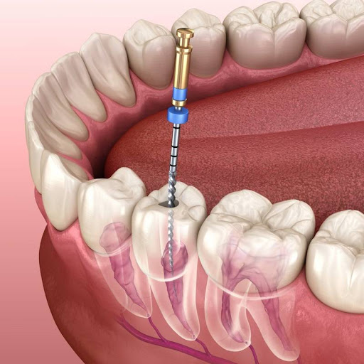 Root Canal Treatment (RCT) is an advanced dental procedure used to save a severely damaged or inf… post image