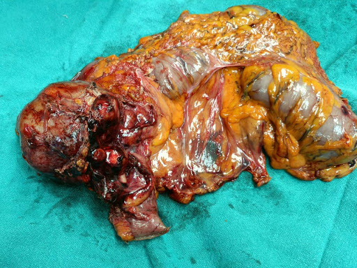 He underwent successful surgery for tumor of large intestine today and is recovering well