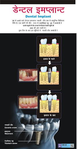 Dental implants post image
