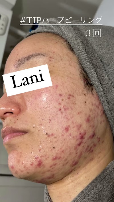 Lani TIP