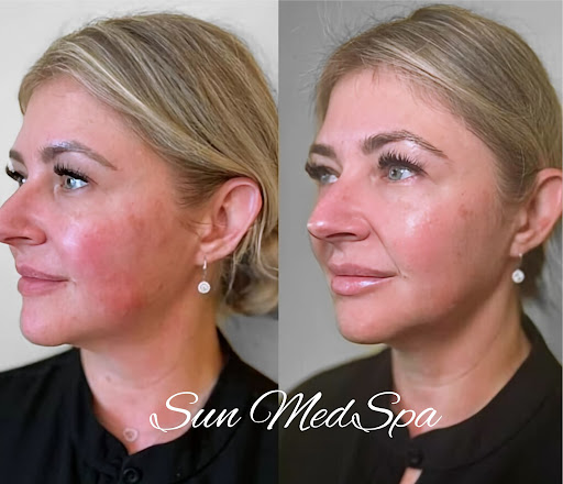 Sun MedSpa