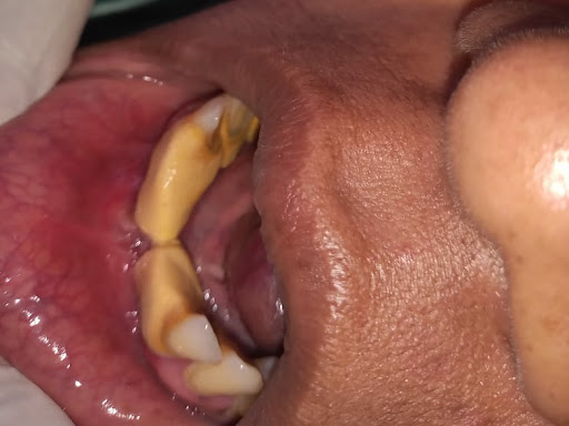 Scalling (oral prophylaxis or teeth cleaning) post image