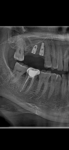 15 % off on Dental implant in Ramjan month post image