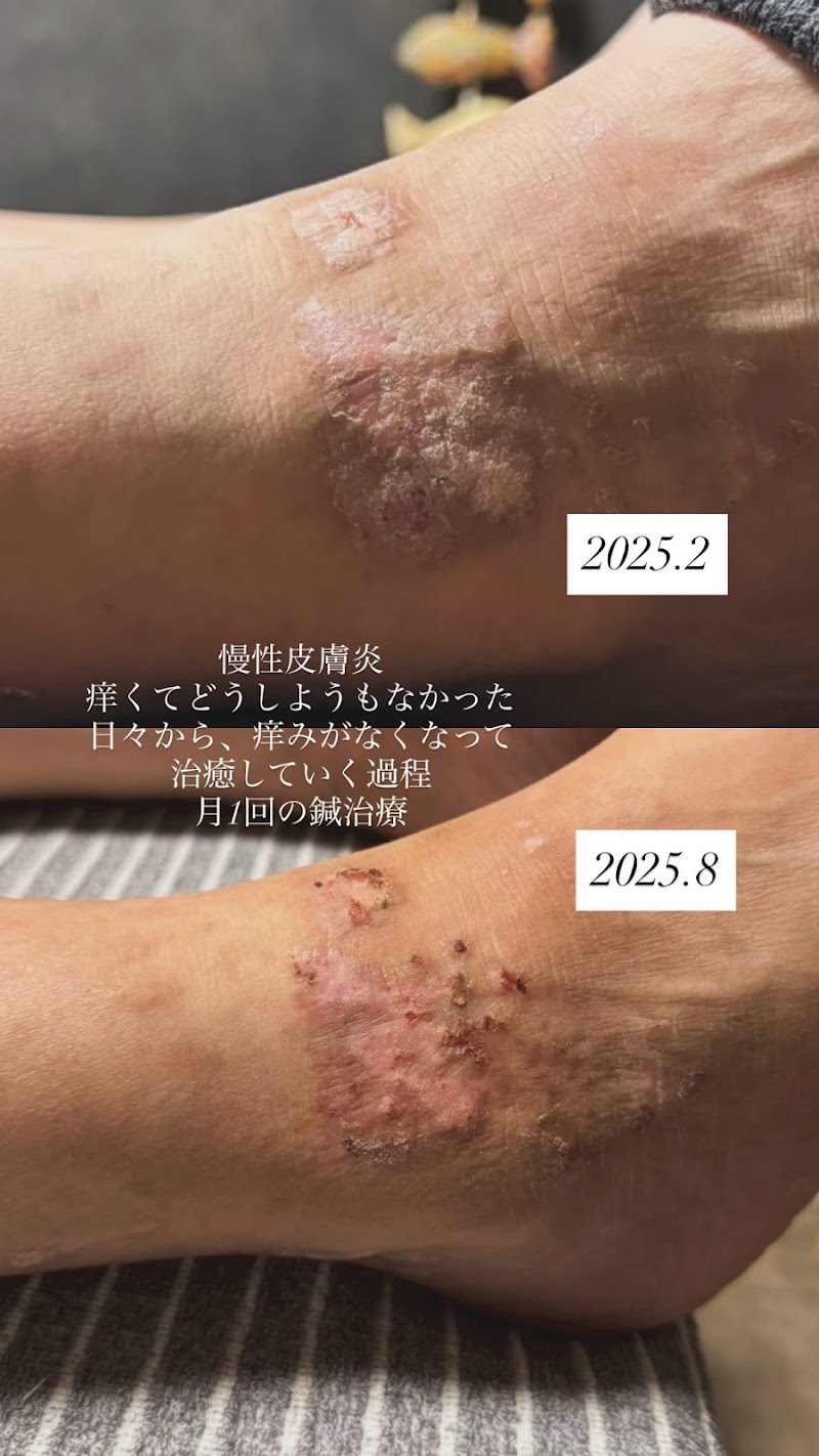 HARI CARE AURUM 鍼治療