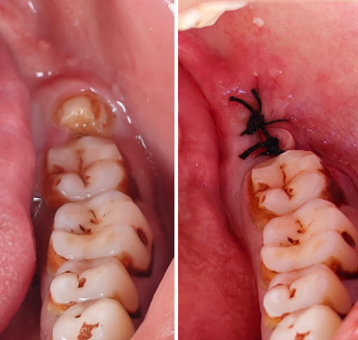 🦷 Wisdom Tooth Removal | Safe & Comfortable Dental Care post image
