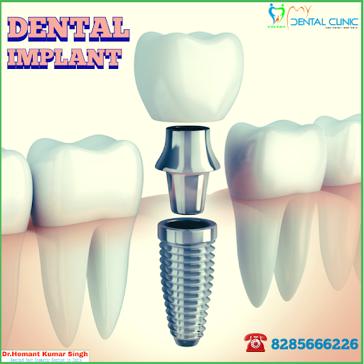 DENTAL IMPLANT post image