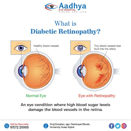 Diabetic Retinopathy is a serious and potentially sight-threatening condition that affects indivi… post image
