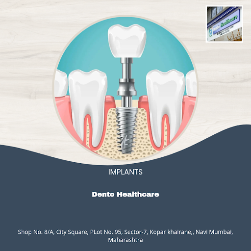Revamp your smile with premium dental implants at Dento Healthcare in Navi Mumbai. The best-selli… post image