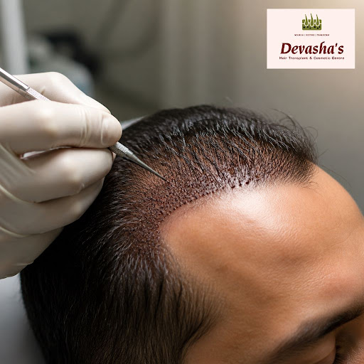 Worried about hair transplant scars? At Devasha's Hair Transplant And Cosmetic Centre - Dr. Jaya… post image