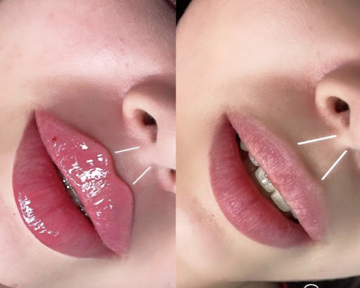 Russian Lip Fillers, medical spa, New York