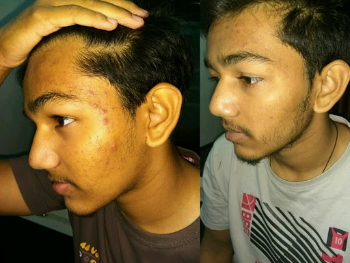 Pimple cure after homeopathic treatment for treatment calll on 9427011155 post image