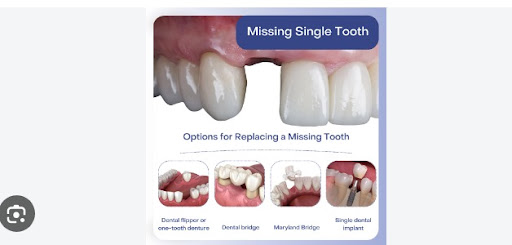 Missing teeth can affect chewing, speech, appearance, and the balance of surrounding teeth. Repla… post image