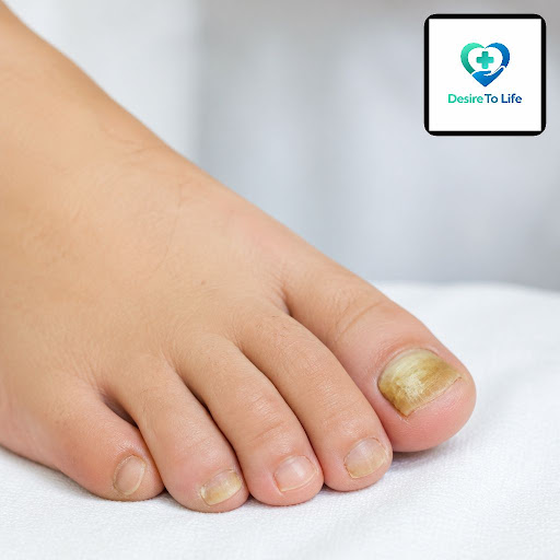 Stubborn nail discoloration, cracking or thickening can be more than a cosmetic issue – it’s ofte… post image
