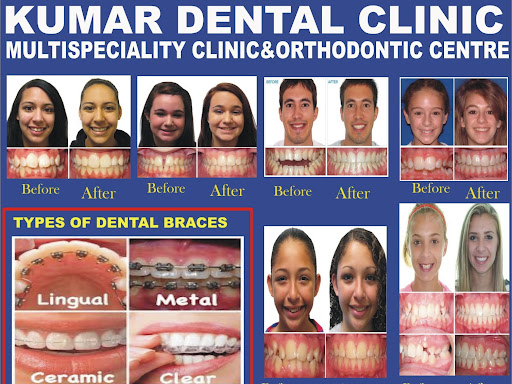 braces post image