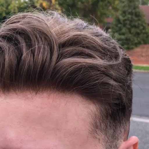 Man Hair - Hair Replacement Solutions Gallery - United States