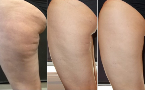 Cavi Med Spa | Body Contouring photo 28