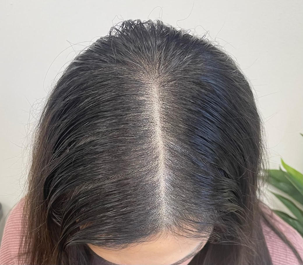 Fort Worth Scalp Micropigmentation