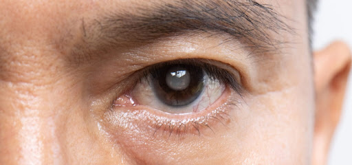 Glaucoma is a serious eye condition that can lead to vision loss if left untreated, making early… post image