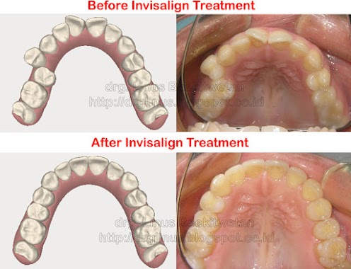 Linus Boekitwetan Dental Care Jakarta Barat, Author: Linus Boekitwetan Dental Care Jakarta Barat