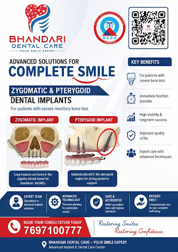 Full arch rehabilitation in a severely atrophic maxilla using Zygomatic and Pterygoid implants—el… post image