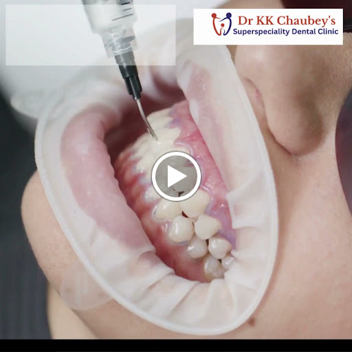 Teeth whitening post image